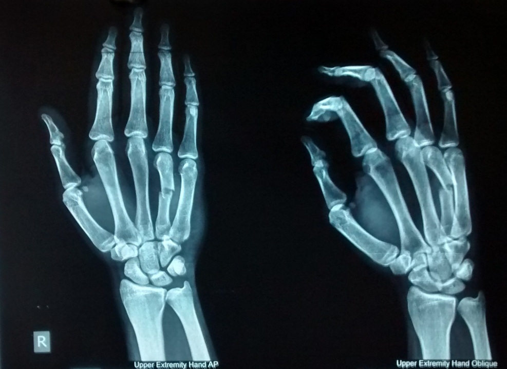 Metacarpal fractures treated by percutaneous Kirschner wire